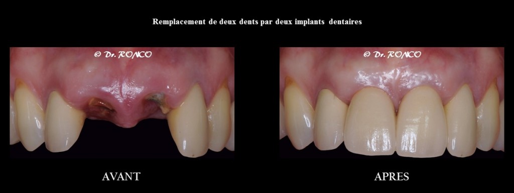 Quest Ce Quun Implant Dentaire Explication De Limplantologie 