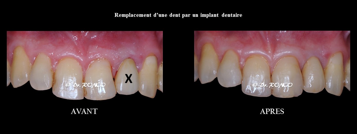 Comment remplacer une dent manquante avec une dent provisoire