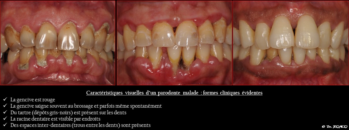 Symptome Parodontite - Clinique dentaire Paris