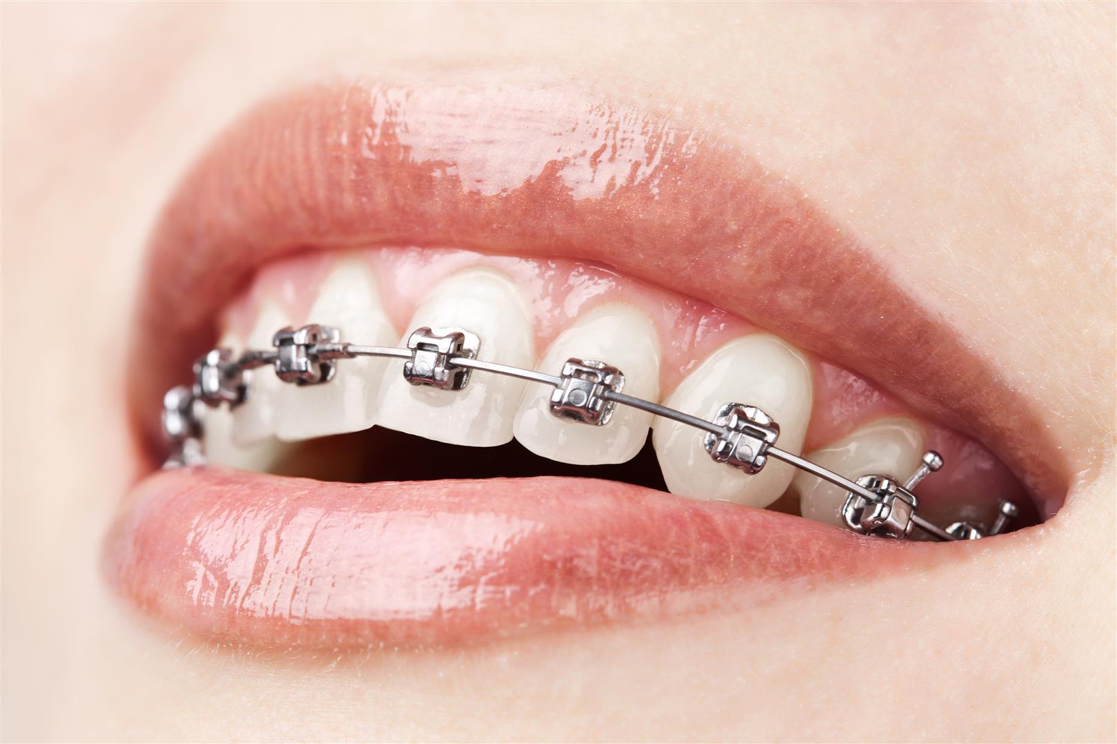 Qu'est ce que l'orthodontie ?