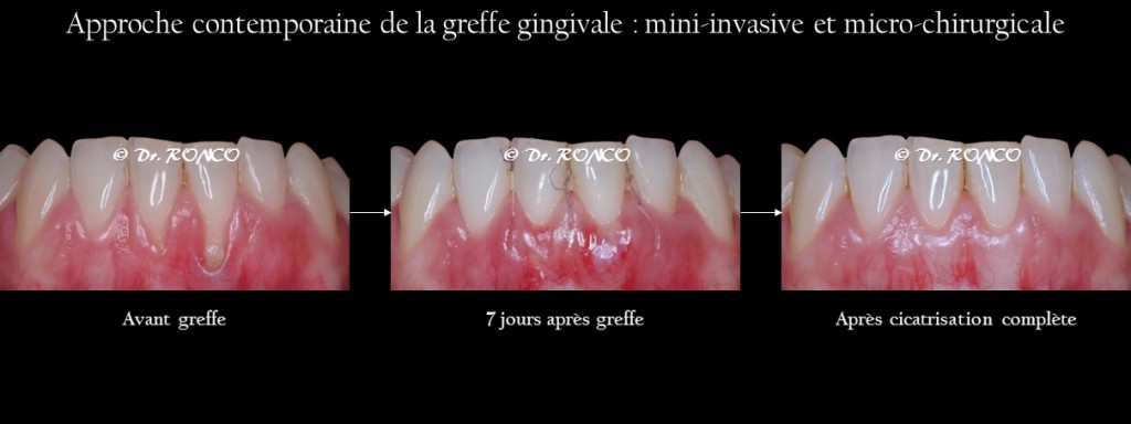 Explication De La Récession Gingivale | Chirurgien Dentiste Paris