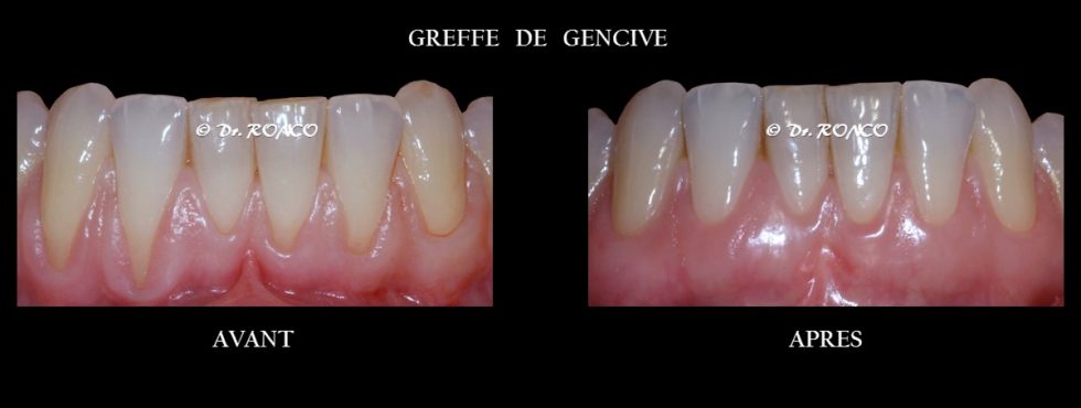Causes de recession gingivale | Explication par le Dentiste Dr Ronco