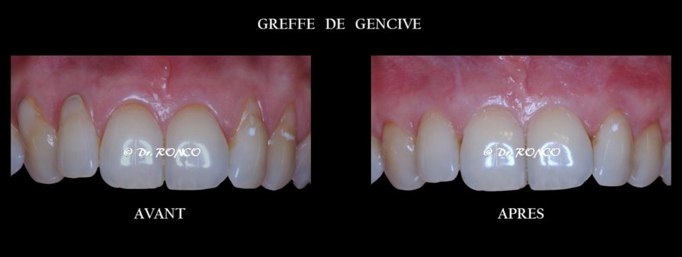 Explication de la récession gingivale | Chirurgien Dentiste Paris