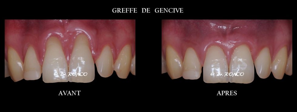 Symptômes et diagnostic d'une récession gingivale | Dr Ronco